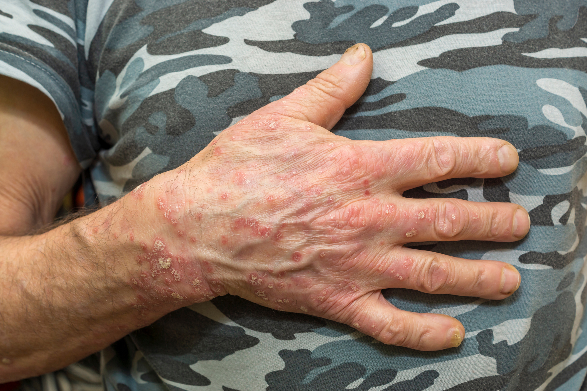Eczema Treatment | Dermatology Associates in Montana