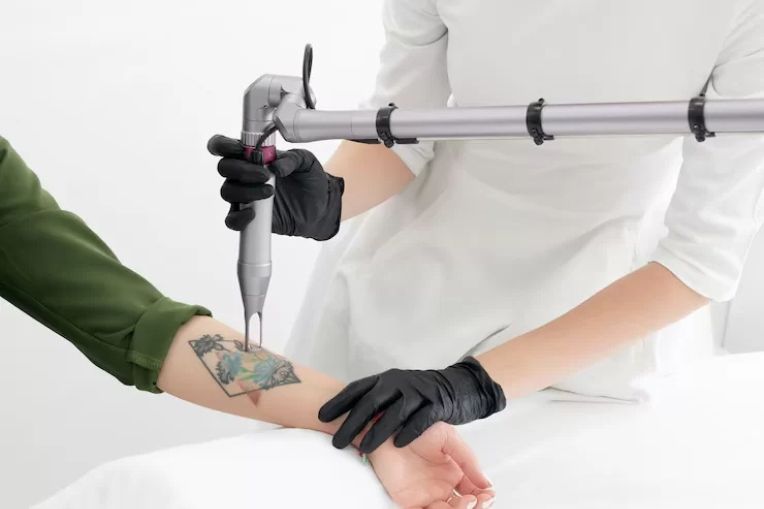 Laser Removal Truth: Does Tattoo Removal Cause Cancer? – Bianco Academy